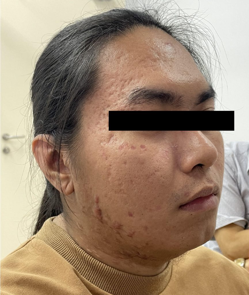 Dr-Gan-GTS-Acne-scars-2