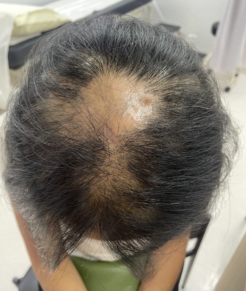 Dr Gan (GTS) - Alopecia areata 1