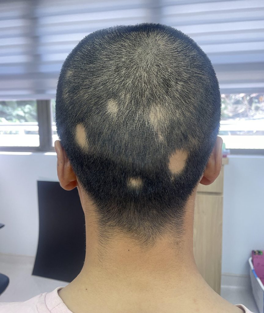 Dr Gan (GTS) - Alopecia areata 2