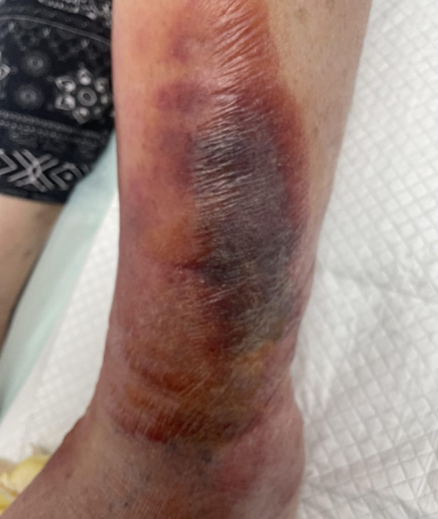 Dr Gan (GTS) - Bacterial infection - cellulitis