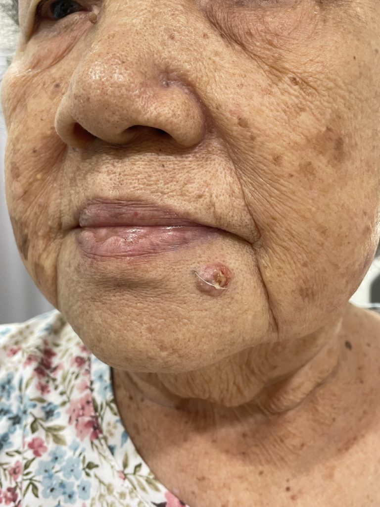 Dr Gan (GTS) - Basal cell carcinoma 2