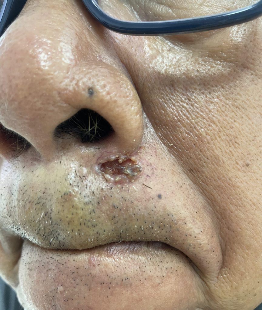 Dr Gan (GTS) - Basal cell carcinoma