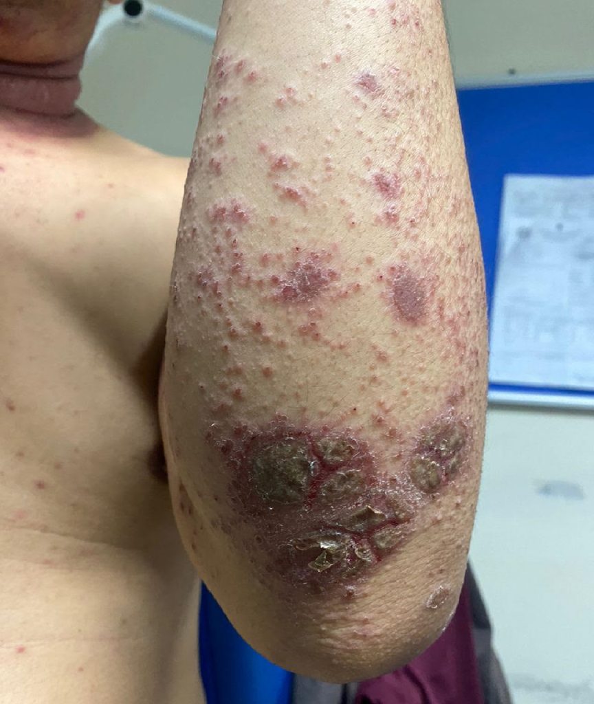 Dr Gan (GTS) - Eczema