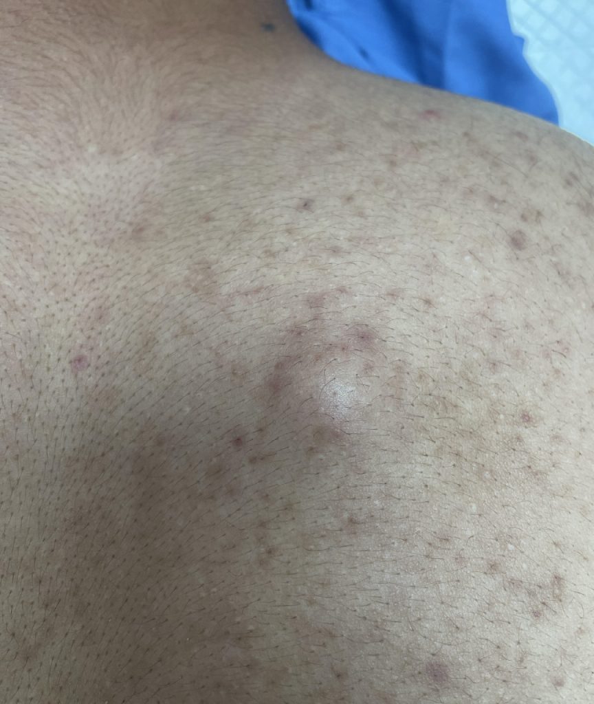 Dr Gan (GTS) - Epidermal cyst