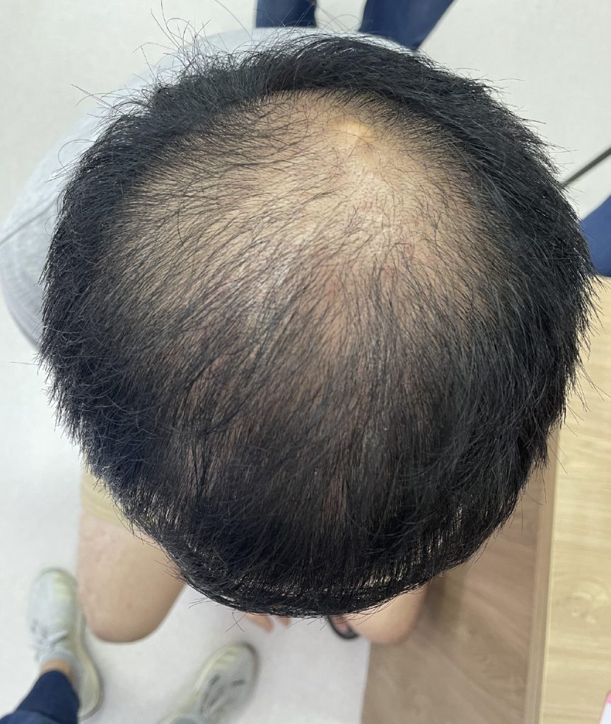 Dr Gan (GTS) - Male pattern baldness 2