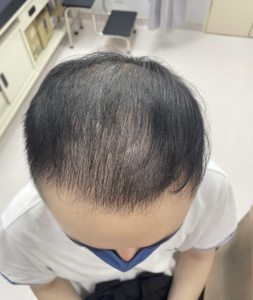 Dr Gan (GTS) - Male pattern baldness