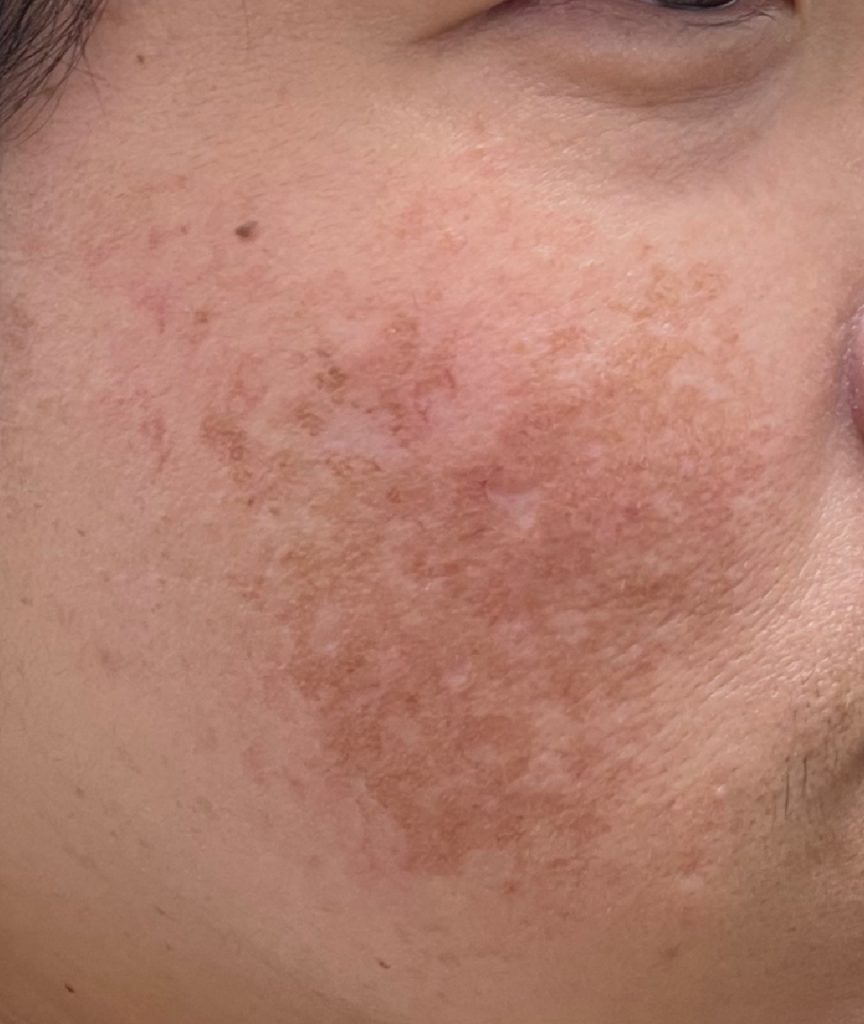 Dr Gan (GTS) - Melasma