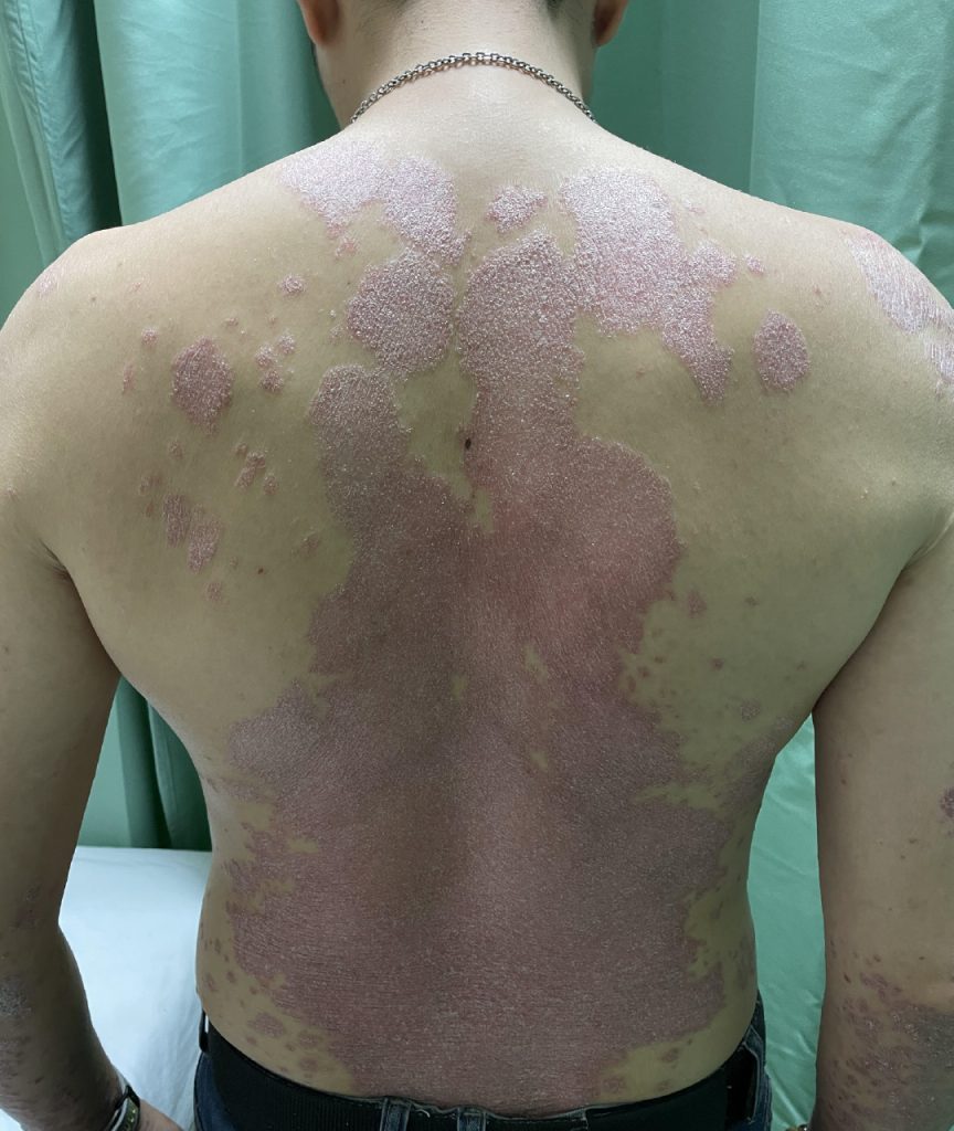 Dr Gan (GTS) - Psoriasis