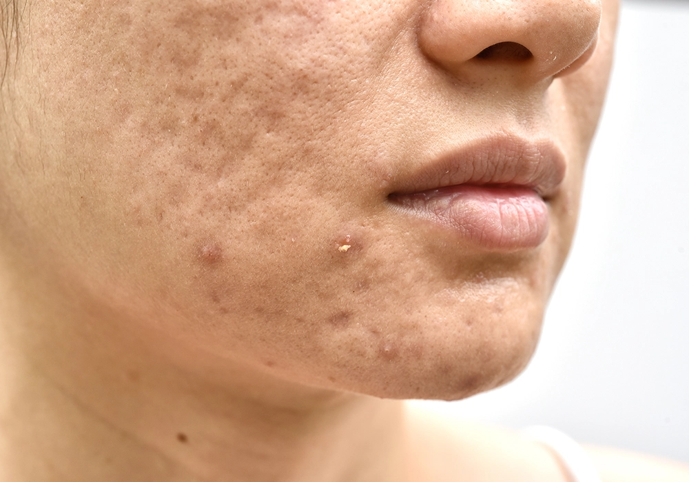 Comedonal acne treatment