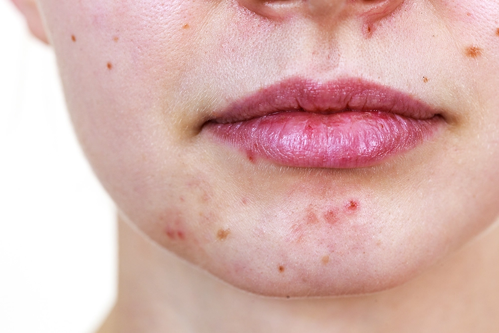 Hormonal acne treatment