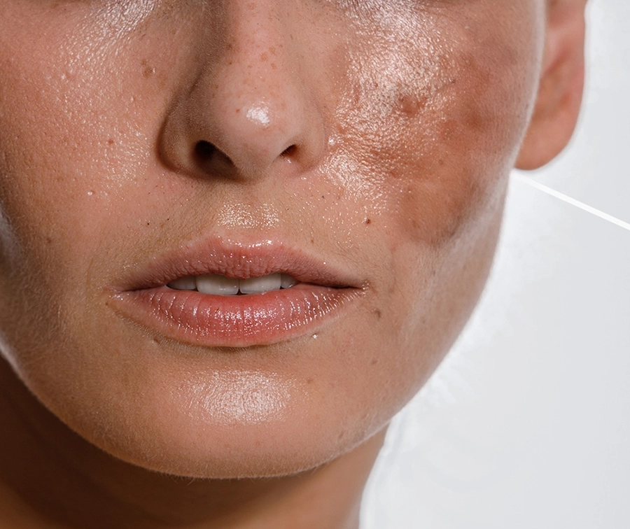 Hyperpigmentation pigmentation treatment malaysia