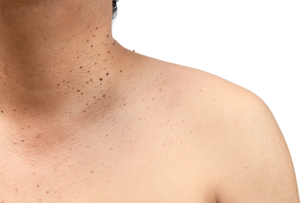 Intertriginous Skin Tags Removal Malaysia