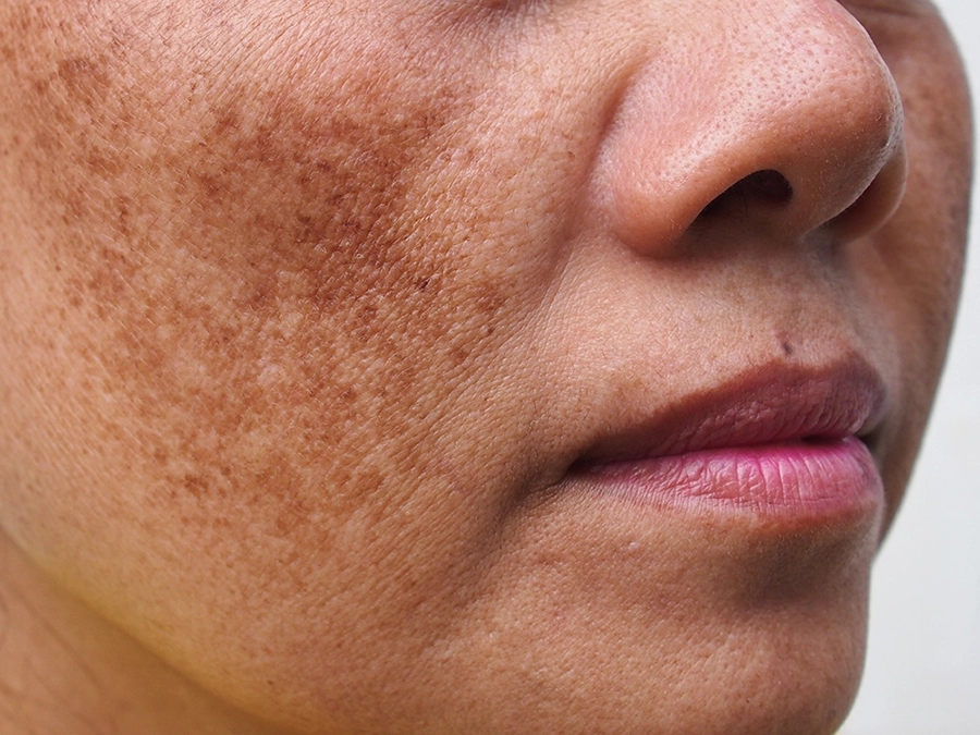 Melasma pigmentation treatment malaysia