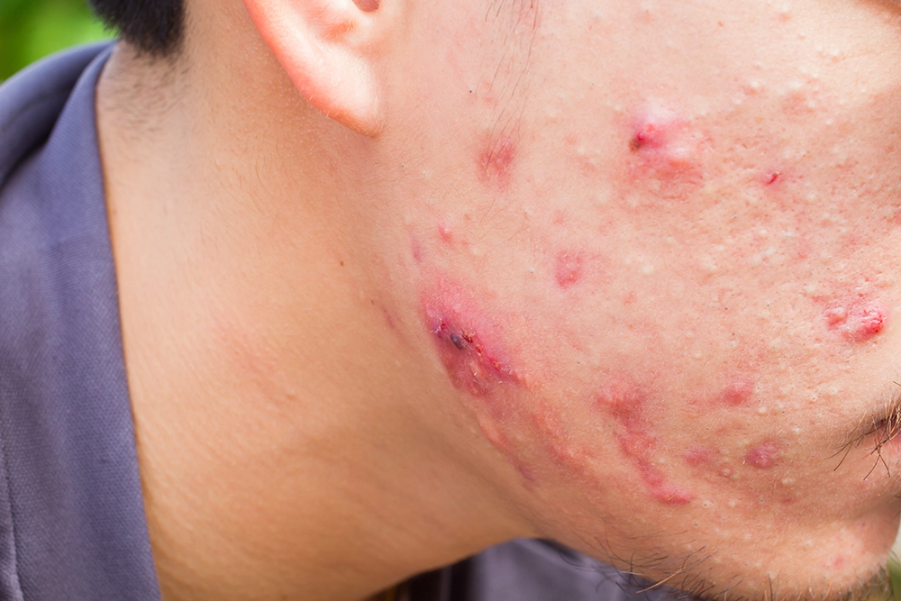 Nodular acne treatment