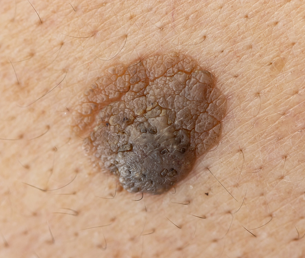 Sun Exposure mole removal