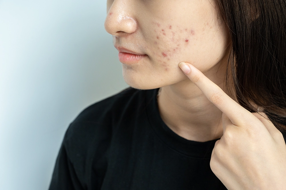 acne treatment malaysia