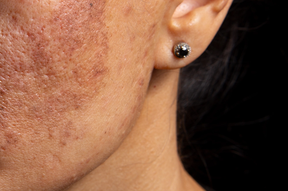 laser treatment for pigmentation malaysia