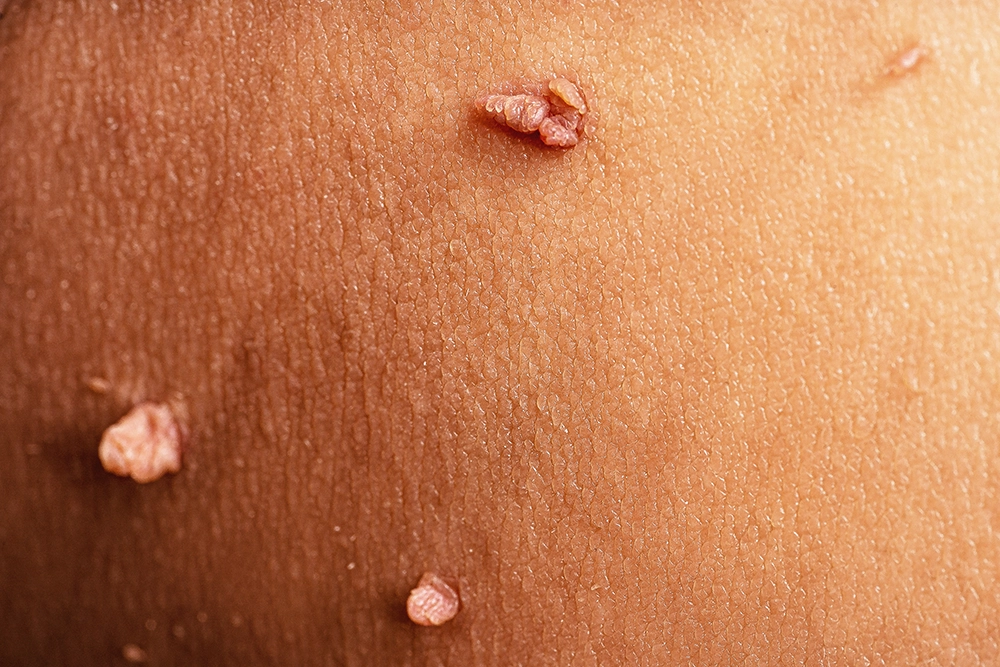 skin tag removal kl