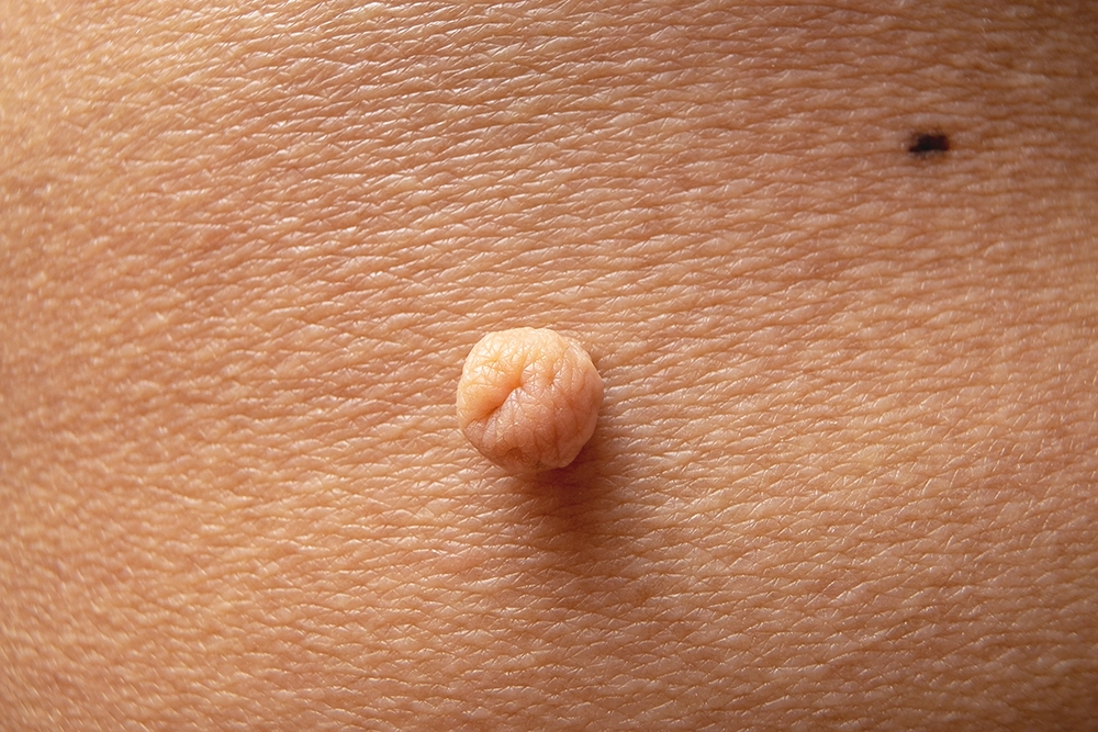 skin tag removal malaysia