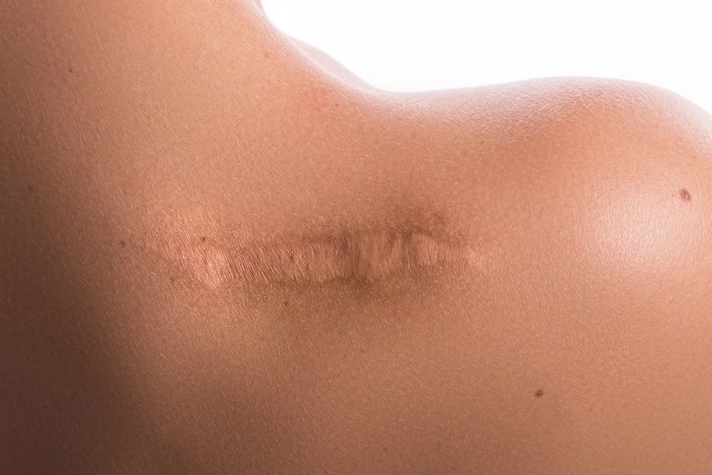 skin tone keloid scar treatment