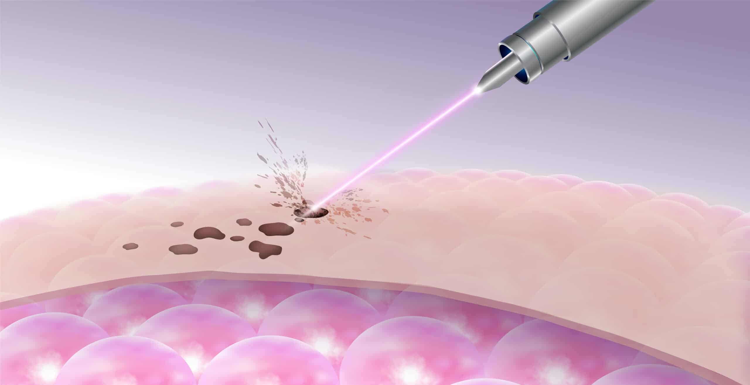 laser dark spot removal