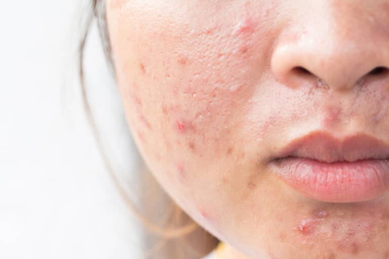 acne treatment for teens & adults