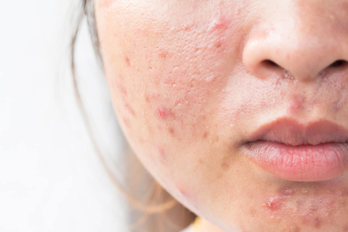 acne treatment for teens & adults