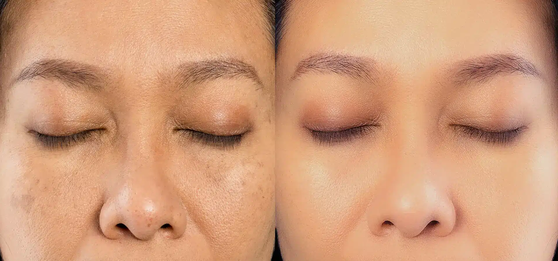 laser treatment for pigmentation