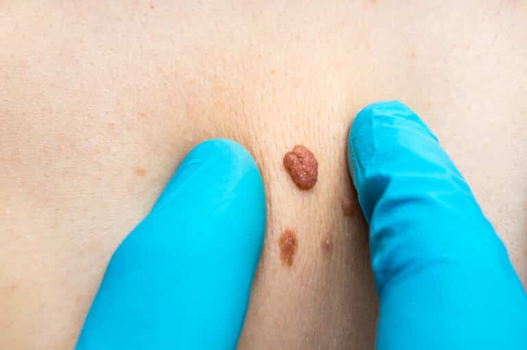 A person’s skin tag is being examined by a dermatologist before administering laser treatment for skin tag removal