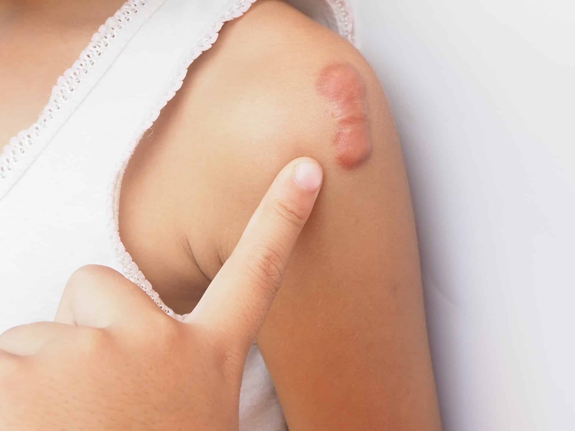Close-up of a raised, reddish keloid scar, marking a person’s shoulder.