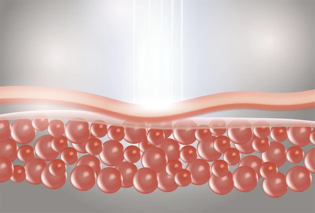 how pico laser works