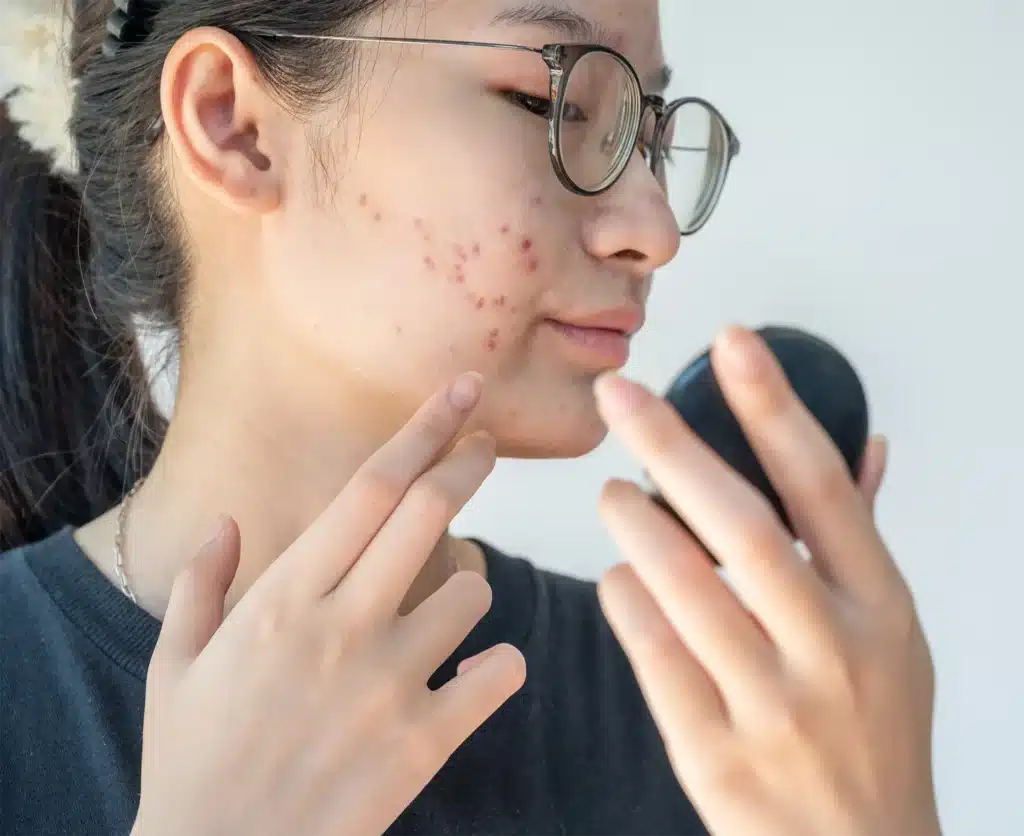 pico laser for acne scars