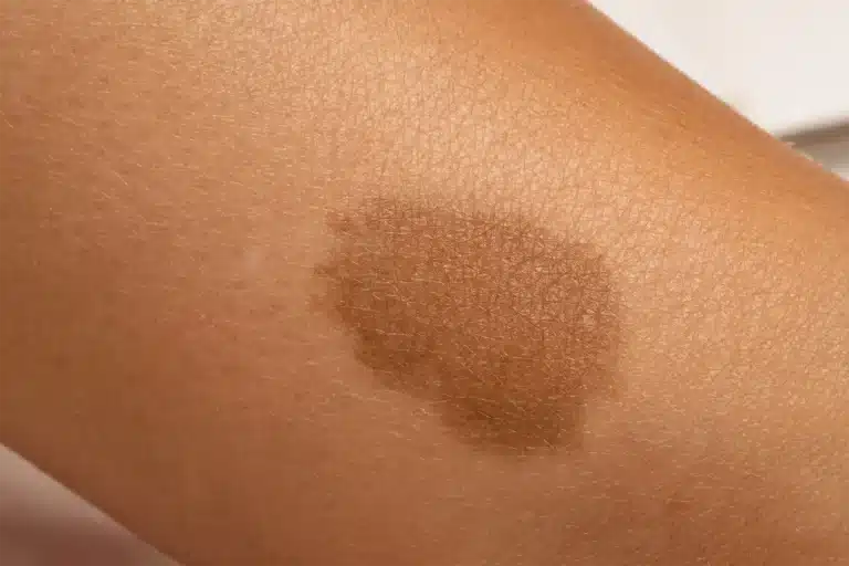 Close-up of a flat brown hyperpigmented patch on tan skin, illustrating the sun-triggered melanin build-up addressed in our pigmentation treatment guide.