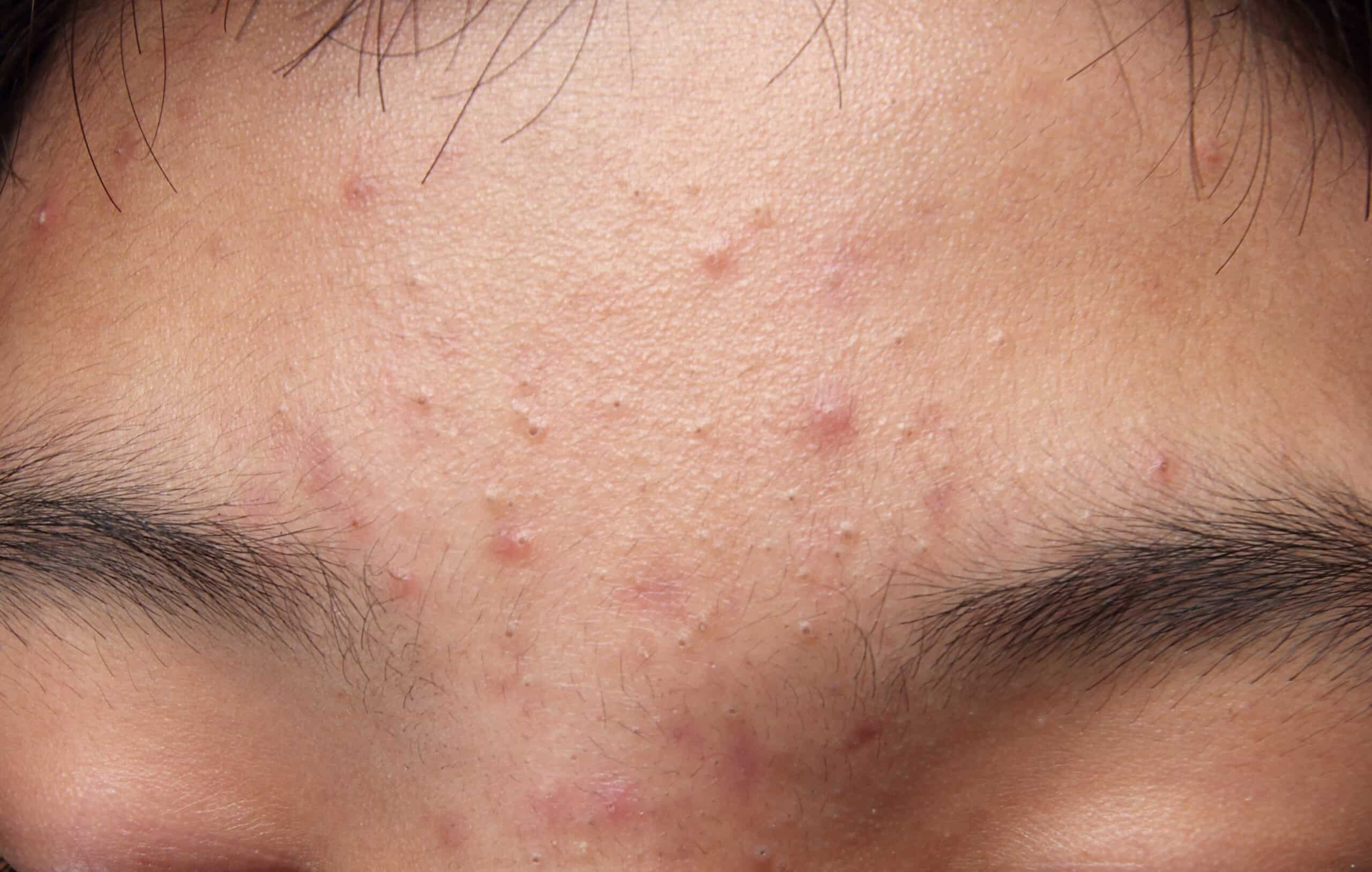 Close-up of inflamed acne and clogged pores on forehead showing different acne types