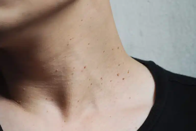 A close-up of a man’s neck showing visible skin tags on the skin surface