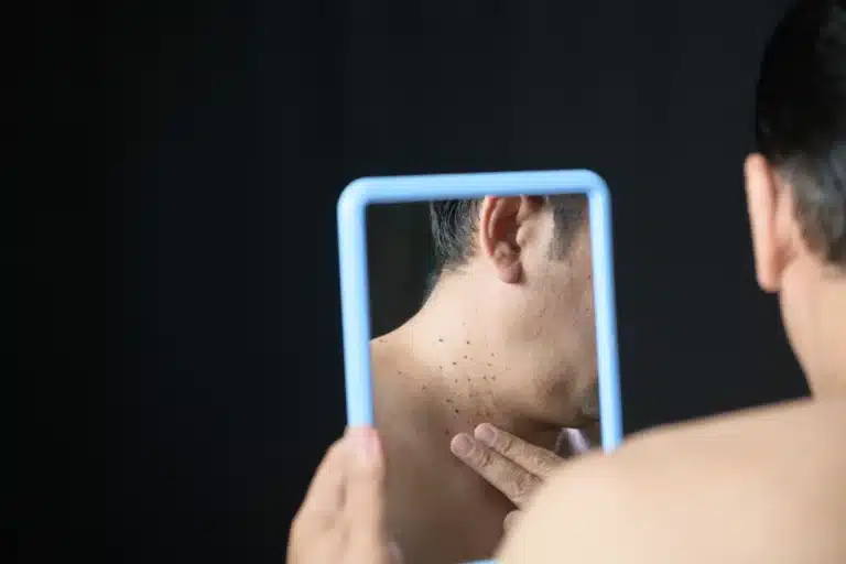 What to Expect When Removing a Skin Tag in Malaysia