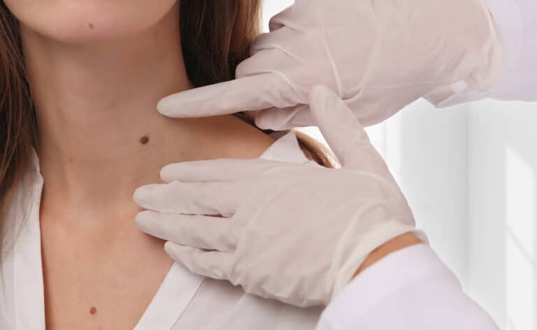 Dermatologist examining flat and raised moles on a patient’s neck before recommending a suitable mole removal treatment in KL.
