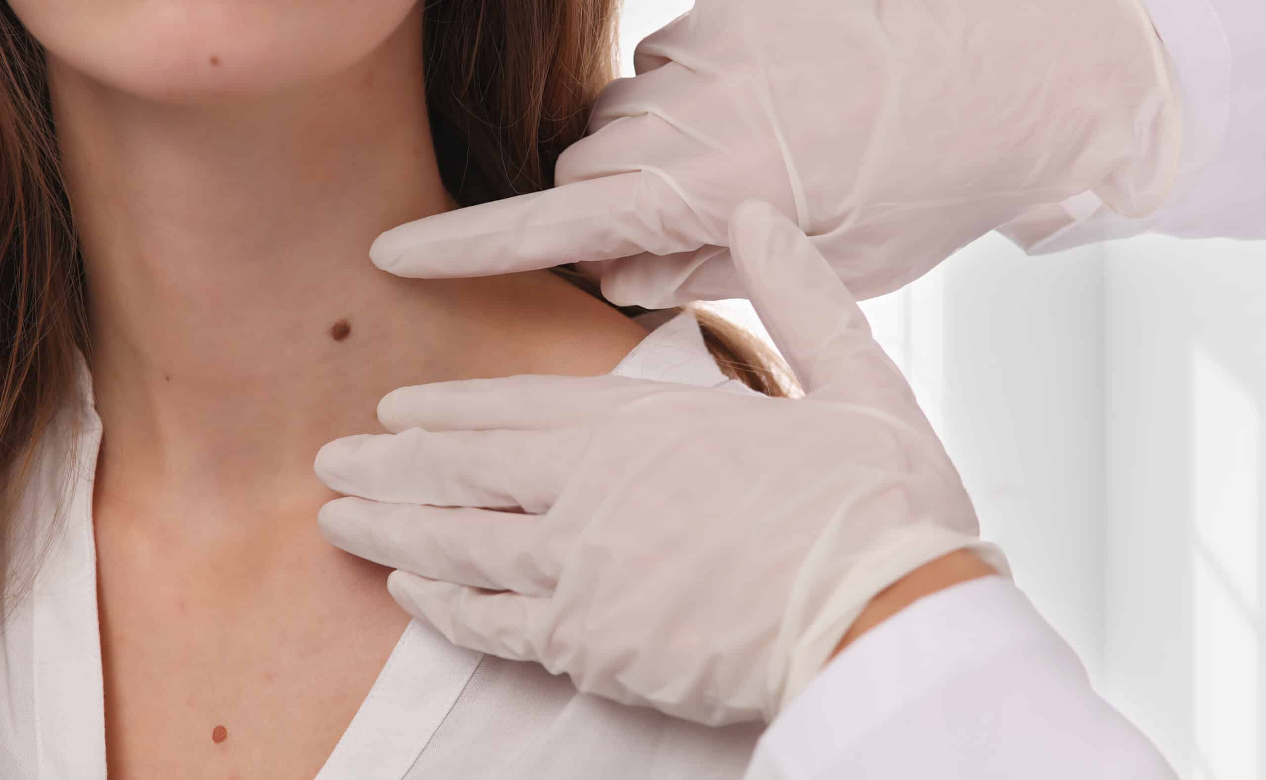 Dermatologist examining flat and raised moles on a patient’s neck before recommending a suitable mole removal treatment in KL.