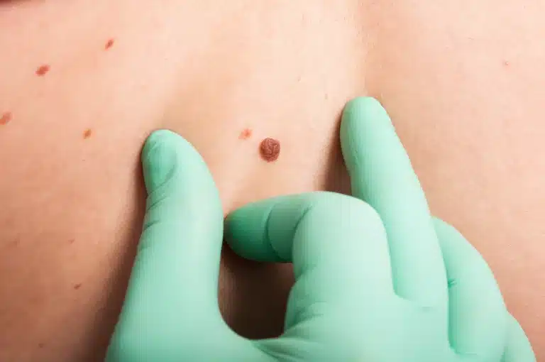 Dermatologist examining a raised mole before medical or cosmetic mole removal in Malaysia for safe and professional treatment